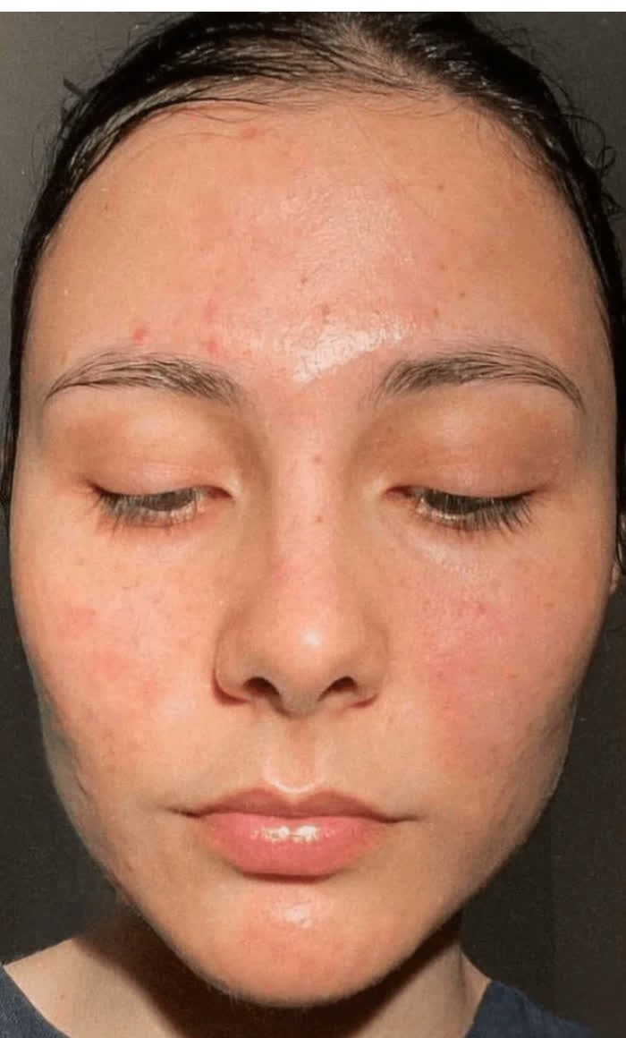 Laura · 6 weeks · Spot Reset Ritual — Before
