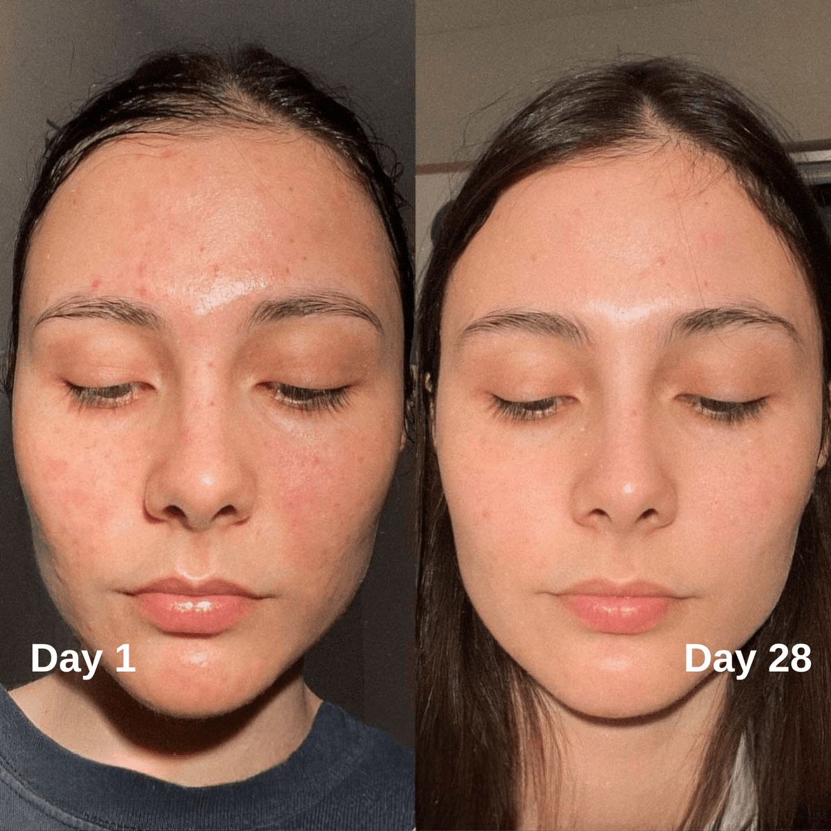 The Ultimate Guide to Radiant Skin: Unlocking the Power of Niacinamide & Kojic Acid Serum