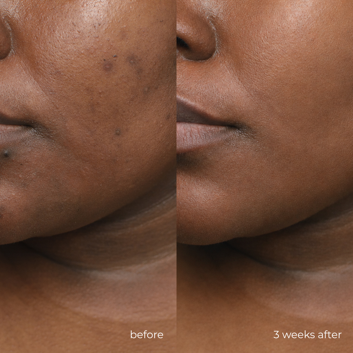KOJIC DRIP — before