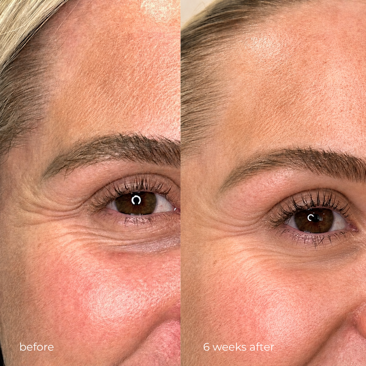 R-Q10 EYE CARE — before